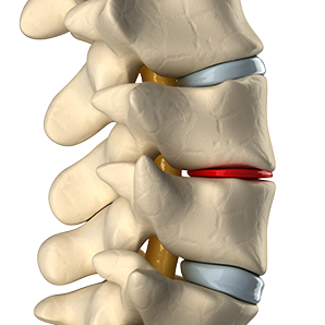 Degenerative Disc Disease